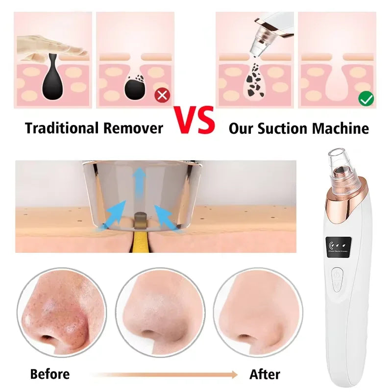 Removedor de Cravos a Vácuo, Limpador Facial de Poros, Dispositivo Elétrico para Remoção de Acne e Espinhas