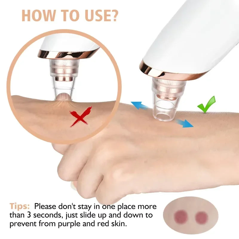 Removedor de Cravos a Vácuo, Limpador Facial de Poros, Dispositivo Elétrico para Remoção de Acne e Espinhas
